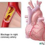 malattie cardiovascolari